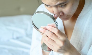 Hati-hati, 5 Makanan Ini Dapat Menimbulkan Jerawat Bandel