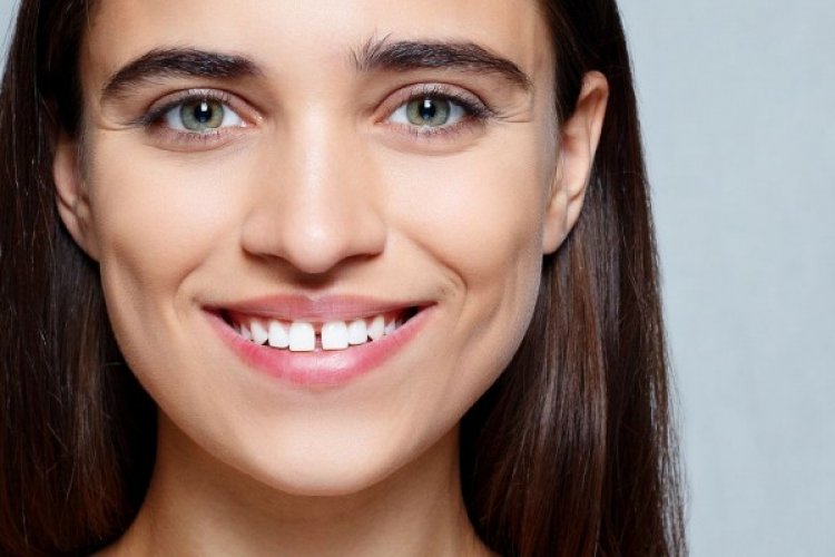 5 Faktor Penyebab Diastema, Kondisi Timbulnya Celah di Antara Gigi