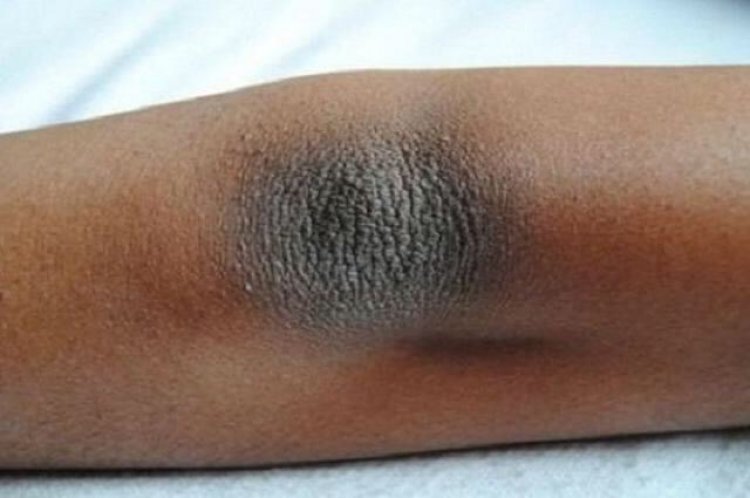 Siku Gelap Bisa Cerah Kembali Cuma Dioles Bahan Alami yang Pasti Ada di Dapur