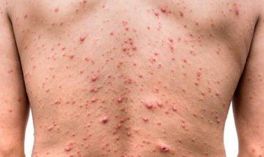 Cara Mengenali Gejala dan Penularan Virus Cacar Monyet