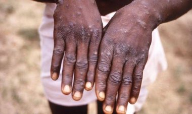 Singapura Kemasukan Cacar Monyet, Pertama di Asean