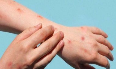 Penularan Cacar Monyet Disebut Tak Semudah Covid-19