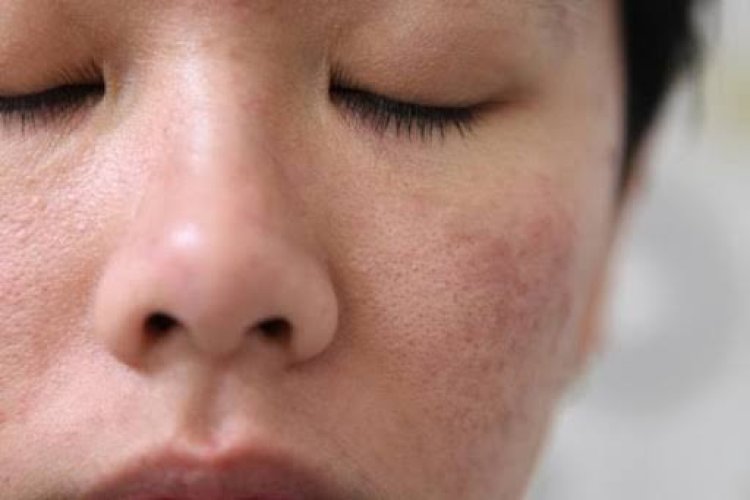 Skin Barrier Adalah Lapisan Terluar Kulit, Ini Ciri-ciri dan Penyebab Kerusakannya