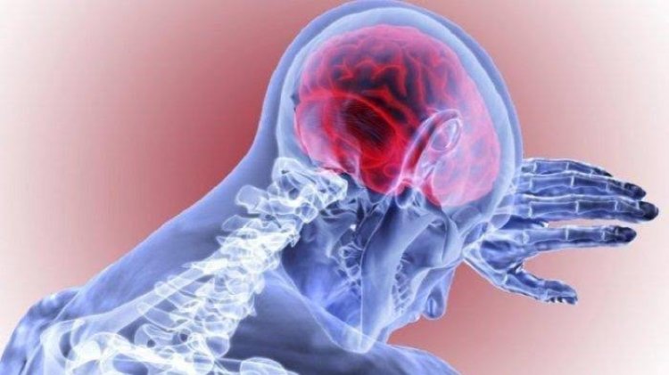 Stroke Bisa Serang Usia Muda 20-30 Tahun, Ini Penyebabnya Kata Ahli Saraf