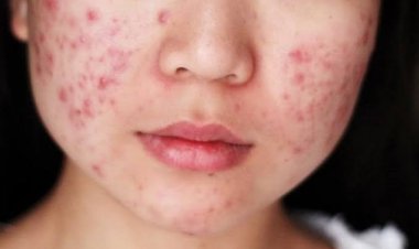 Cara Mencegah Jerawat, Coba Hindari Jenis Makanan Berikut Ini