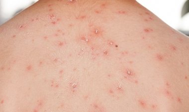 Pemko Pekanbaru Waspadai Ancaman Cacar Monyet