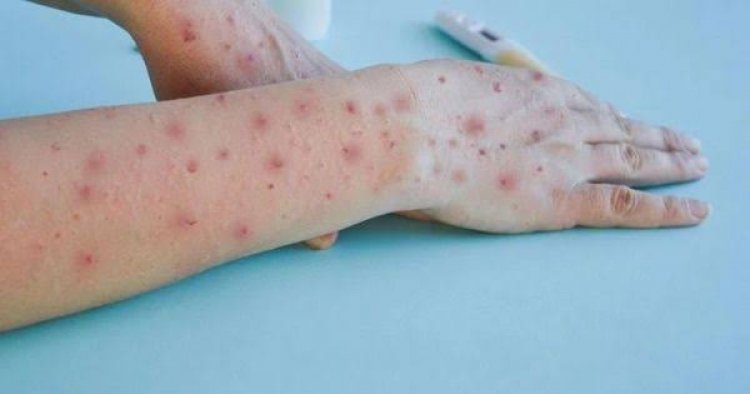 Virus Mpox Belum Masuk ke Riau, Kadiskes Minta Warga Tetap Waspada