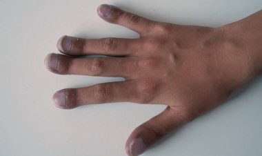 Gejala Penyakit Jantung Bawaan pada Anak, Termasuk Sering Keringatan