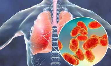 Kerap Batuk seperti Ini? Hati-hati, Bisa jadi Tanda 'Paru-paru Basah'