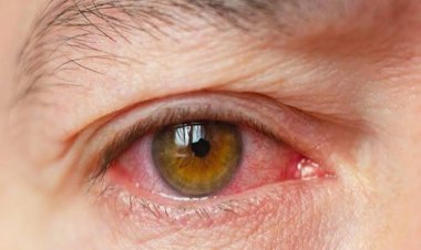 Ini Gejala Mata Lelah Akibat Keseringan Main Gadget dan Cara Mengatasinya