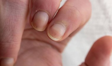 Kolesterol Tinggi Bisa Dideteksi Melalui Kuku Anda, Waspadai Tanda-tanda Ini