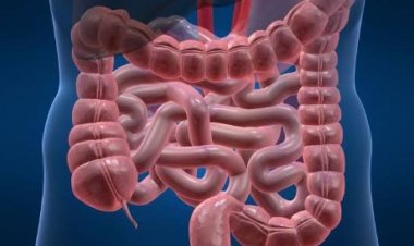 Apa Itu Kanker Kolorektal? Ini Penyebab, Faktor Risiko, dan Gejalanya