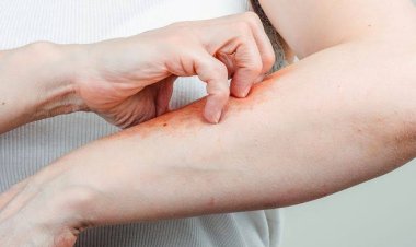 Dokter Ungkap 6 Gejala Sakit Ginjal yang Bisa Muncul di Kulit