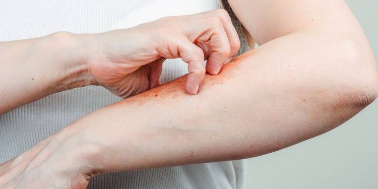 Dokter Ungkap 6 Gejala Sakit Ginjal yang Bisa Muncul di Kulit