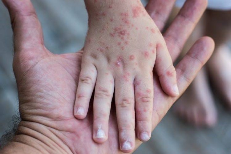 Imunisasi Campak di Puskesmas di Pekanbaru Gratis