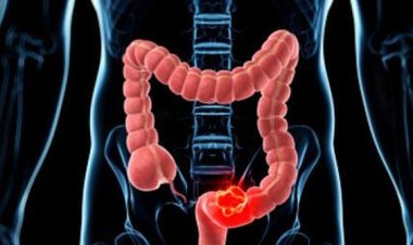 Banyak Gen Z Kena Kanker Usus Besar, Dokter Bicara Kemungkinan Pemicunya