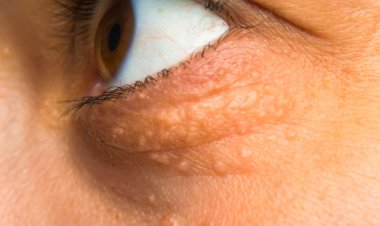 Tanda Kolesterol Tinggi yang Muncul di Mata, Perhatikan Ini!