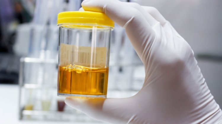 4 Tanda Kerusakan Ginjal yang Bisa Terlihat dari Air Kencing