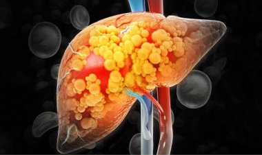 Usia 30-an Banyak Kena Fatty Liver, Waspada Silent Killer