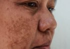Lebih dari 90% Penderita Melasma adalah Perempuan, Ini Penyebabnya